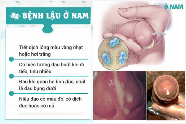 Dau-hieu-benh-lau-o-nam