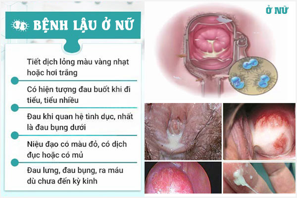Dau-hieu-benh-lau-o-nu