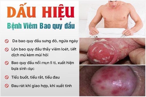 Dau-hieu-viem-bao-quy-dau