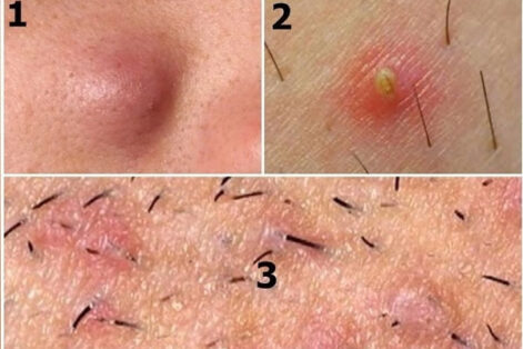 Nổi mụn mủ ở vùng kín nam giới có sao không? Địa chỉ khám hỗ trợ điều trị uy tín ở đâu?