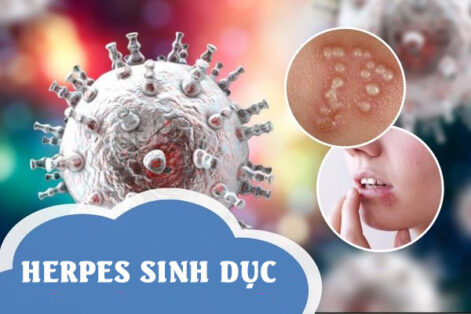 Bệnh Herpes – Dấu hiệu & Cách điều trị hiệu quả