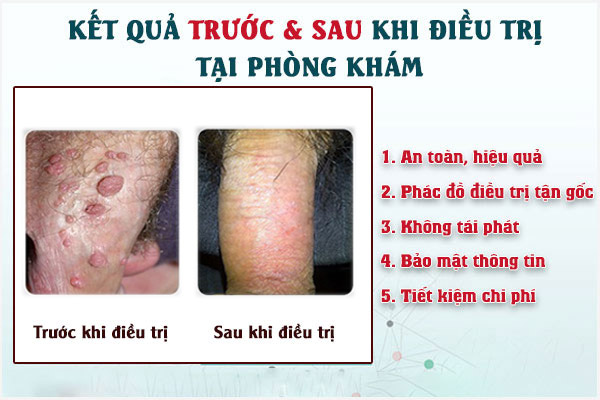 Ket-qua-dieu-tri-sui-mao-ga