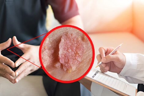 Đâu là phòng khám sùi mào gà uy tín, chất lượng tại Hải Dương