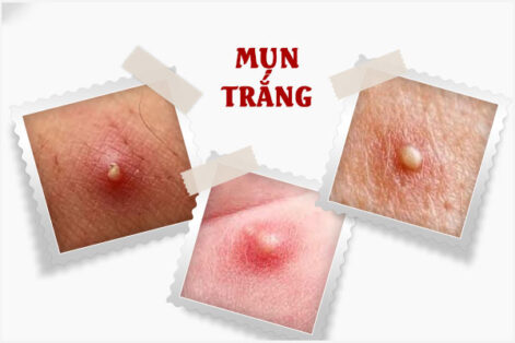 Mụn trắng ở nữ giới báo hiệu sớm của bệnh xã hội đừng nên chủ quan!