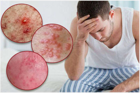 Nổi mụn đỏ ở dương vật có sao không? 3 Cách khắc phục nhanh, tiết kiệm