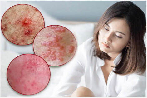 Nổi mụn đỏ ở vùng kín nữ giới là bị gì? Cách khắc phục nhanh và hiệu quả