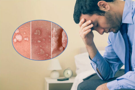 Top 4 bệnh xã hội thường gặp – Dấu hiệu và cách điều trị