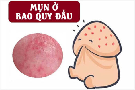 Nổi mụn ở bao quy đầu là bị gì? Có nguy hiểm không?