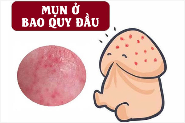 Mun-o-bao-quy-dau