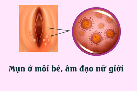 Mụn ở môi bé: Nguyên nhân, Triệu chứng và Cách khắc phục hiệu quả.