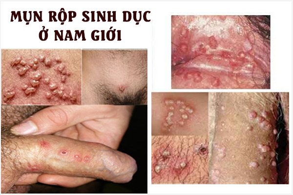 Mun-rop-sinh-duc-o-nam-2