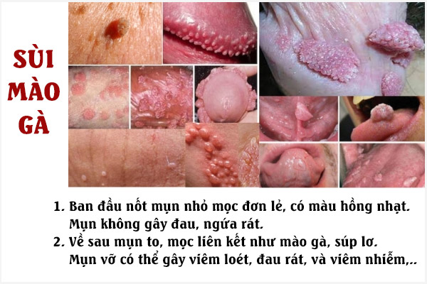 Sui-mao-ga-o-duong-vat